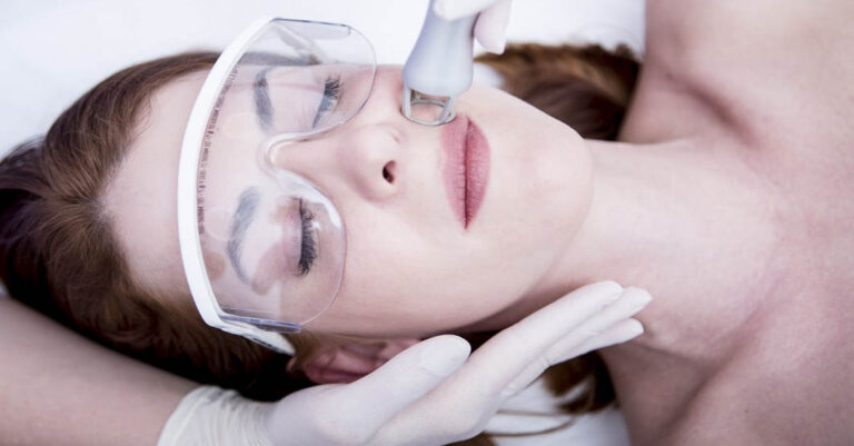 carbon laser peel